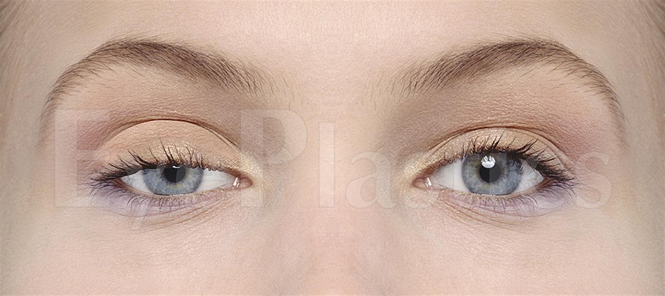 ptosis-droopy-eyelid-causes-treatment-milan-eye-center